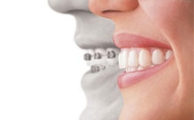 Invisalign